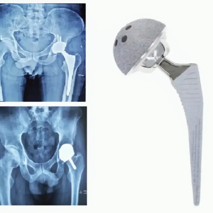 Artificial Femoral Head Replacement of Titanium TI-6AI-4V